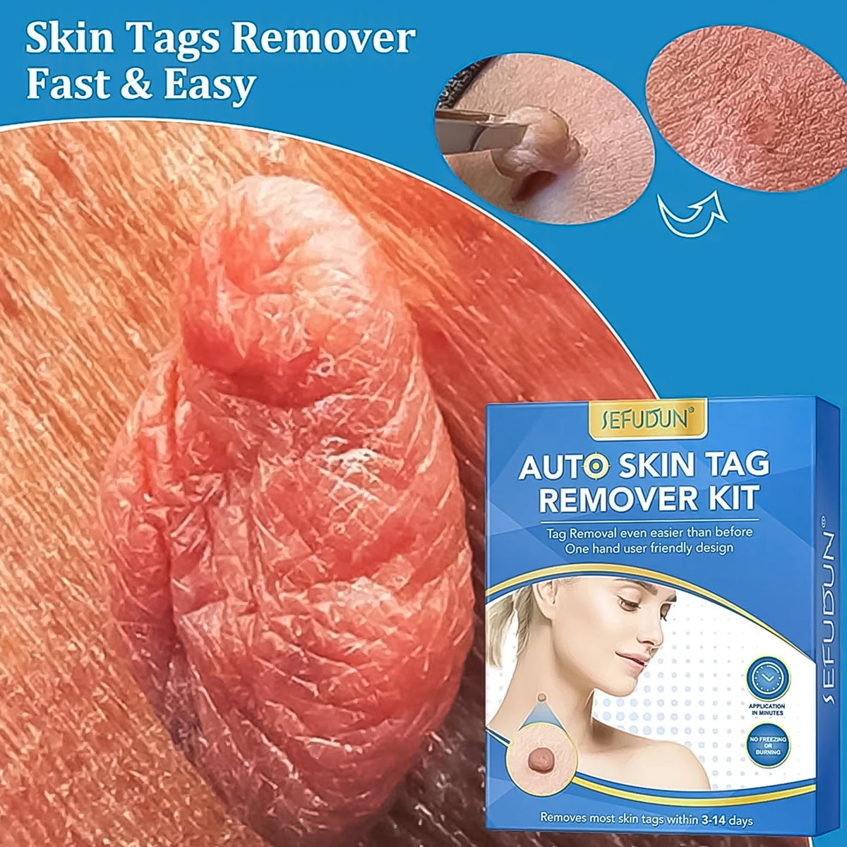 Skin Tag Remover Kit with Applicator and Bands – detail view