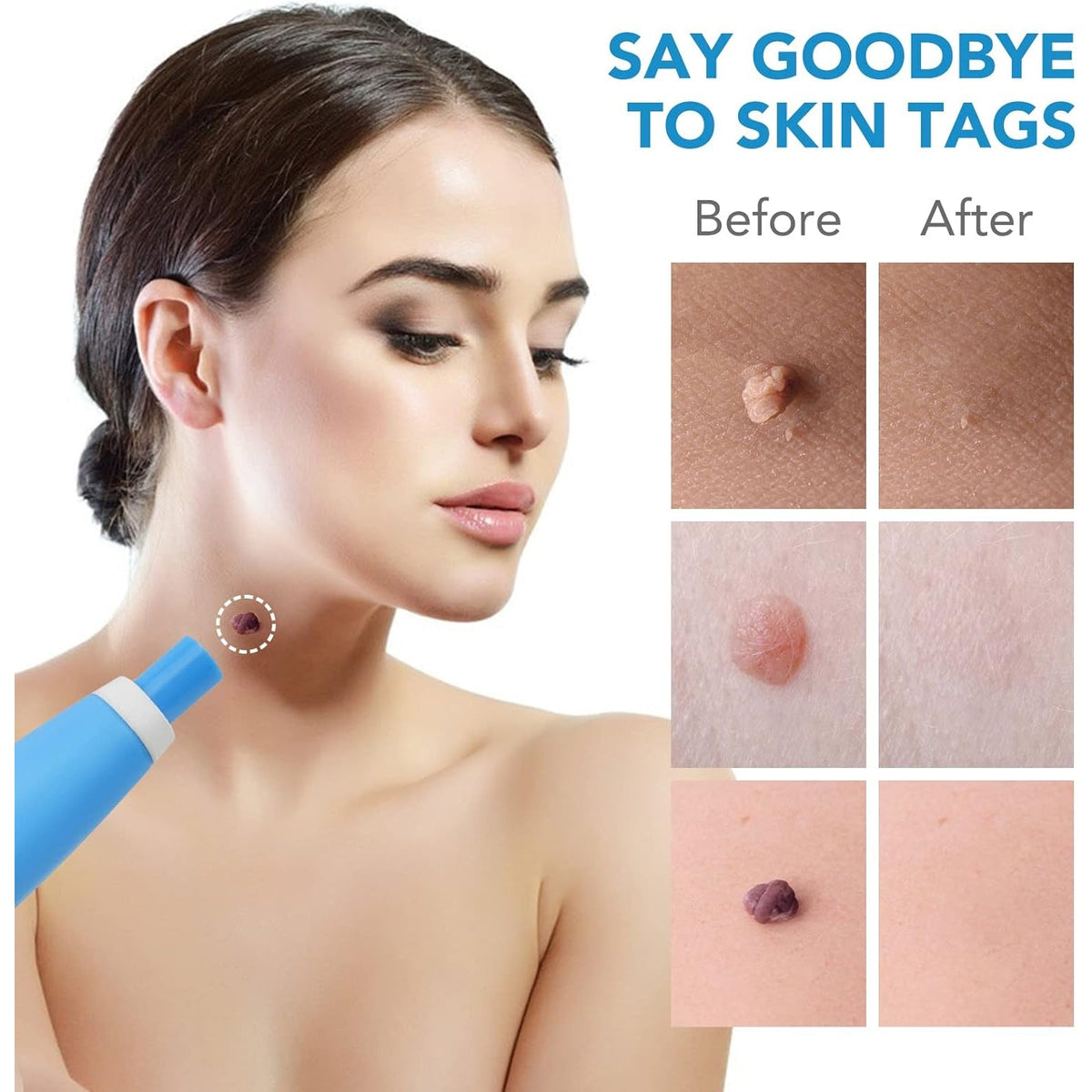 Skin Tag Remover Kit with Applicator and Bands – view 7